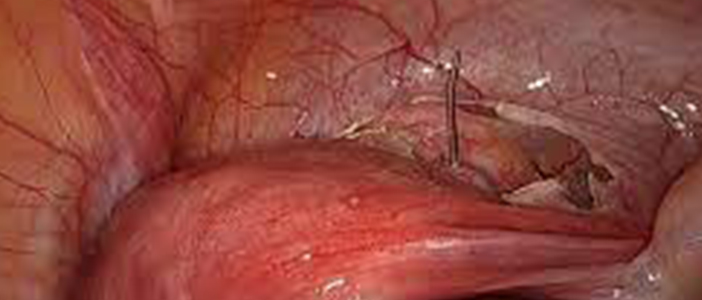 Laparoscopic Abdominal Cerclage